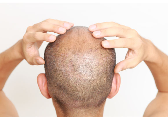 how to regrow all lost hair